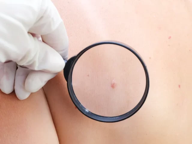 Câncer de pele